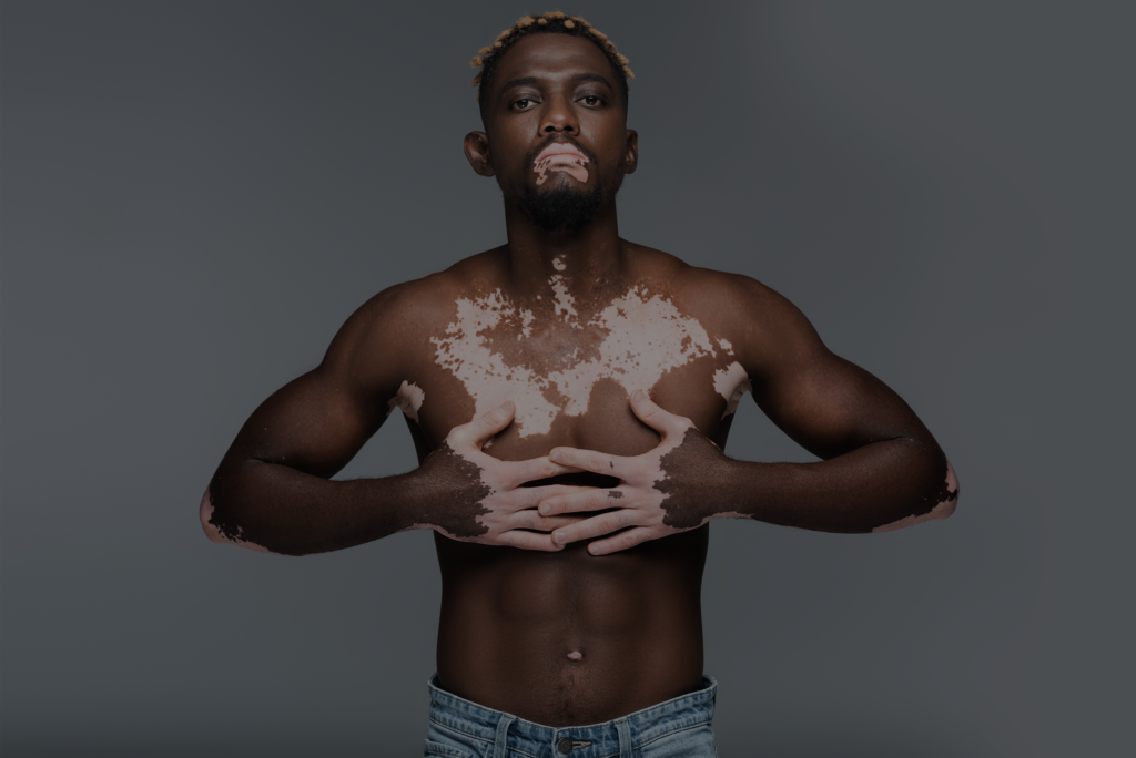 Vitiligo in African Americans