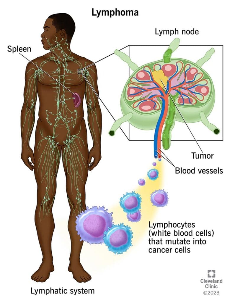 Lymphoma diagram