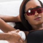 Black woman with hidradenitis suppurativa (HS) receiving laser hair removal treatment