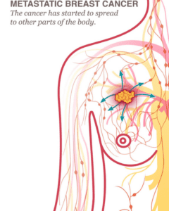 Where Does Breast Cancer Spread? 1 Metastatic Breast Cancer