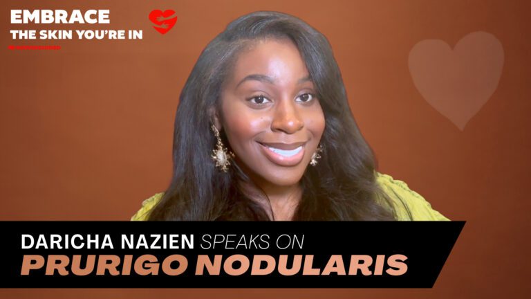 Medicines Available for Prurigo Nodularis 1 Acclinate PN Daricha Nazien FULL